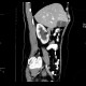 Hydronephrosis, grade I, bilateral, initial: CT - Computed tomography